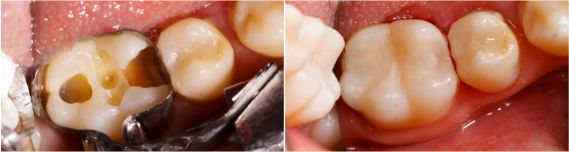 Composite Fillings - Tooth-Colored Fillings