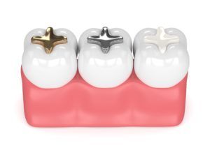 Composite vs amalgam fillings