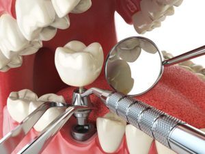 Dental implant placement