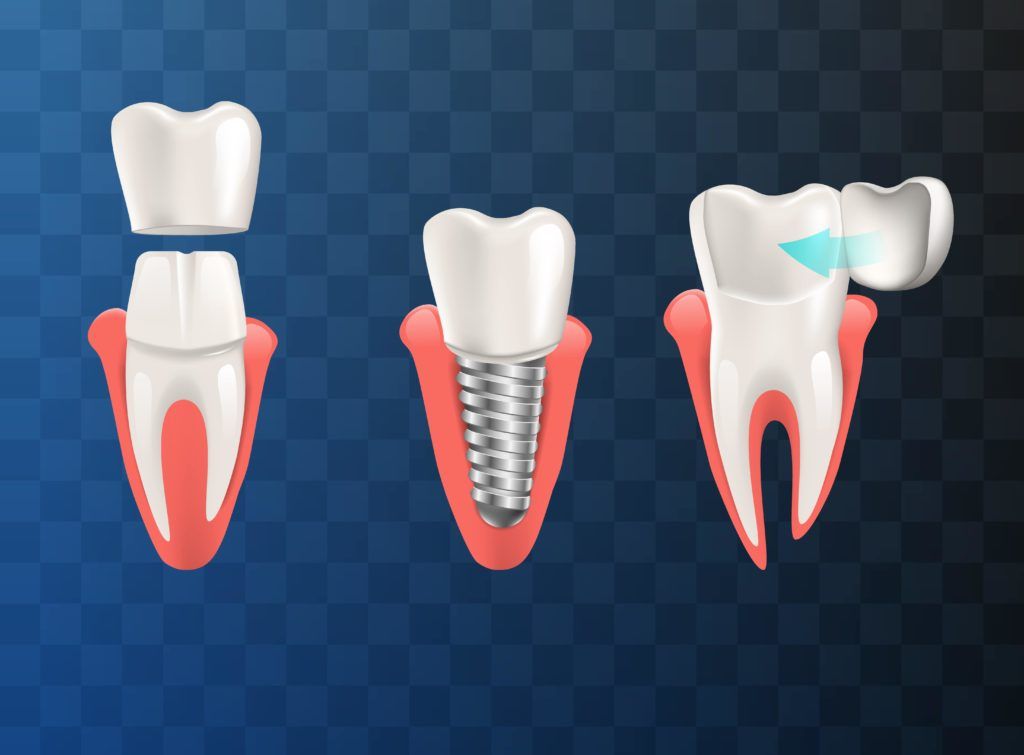 Left to Right: Dental Crown, Dental Implant, Veneer