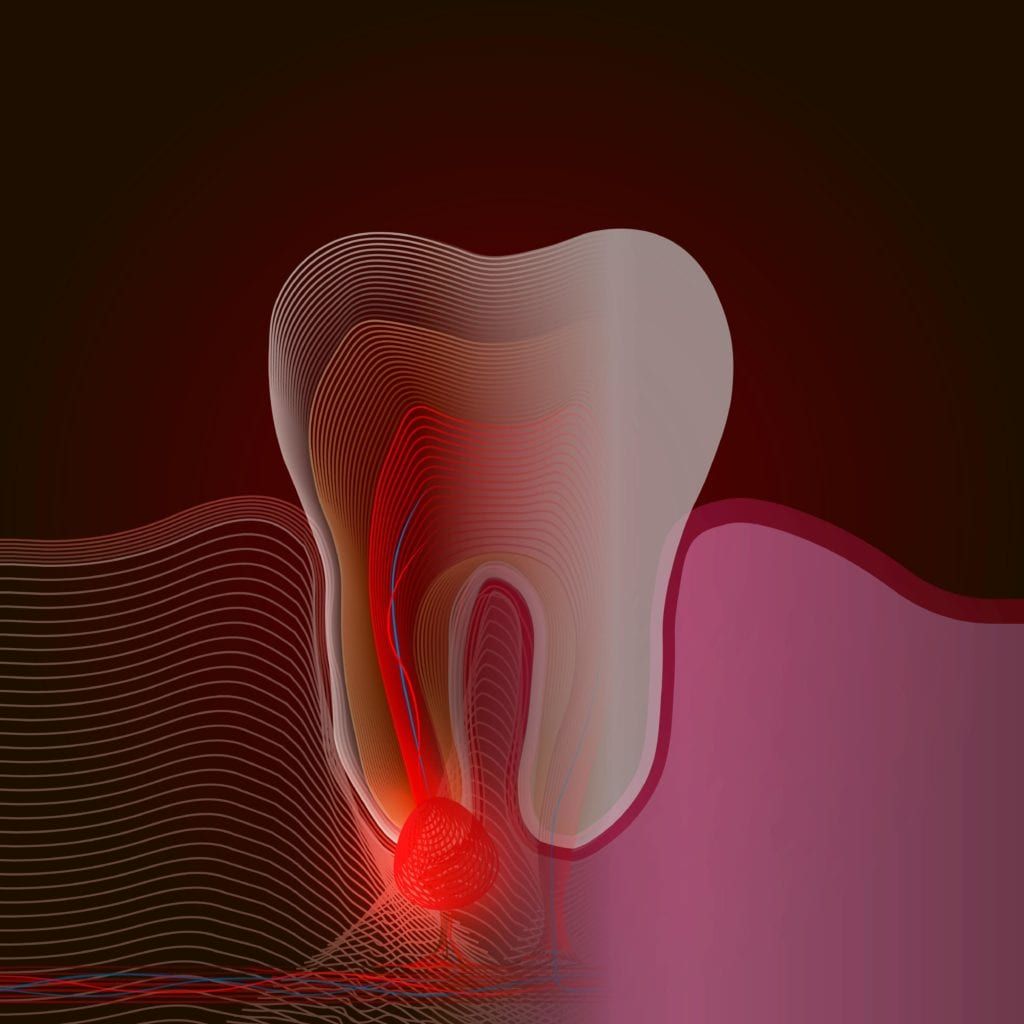 Diagram of tooth showing the layers and the nerve