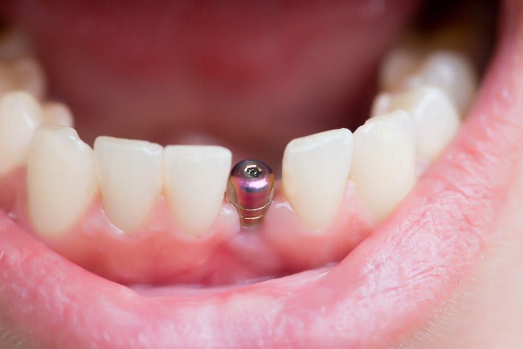 Implant without prosthetic