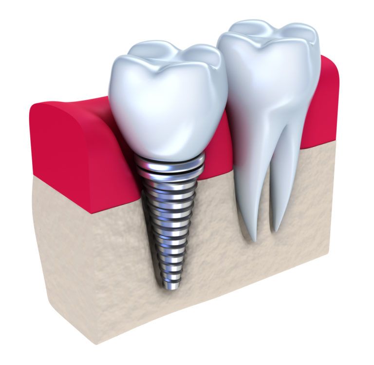 what are dental implants