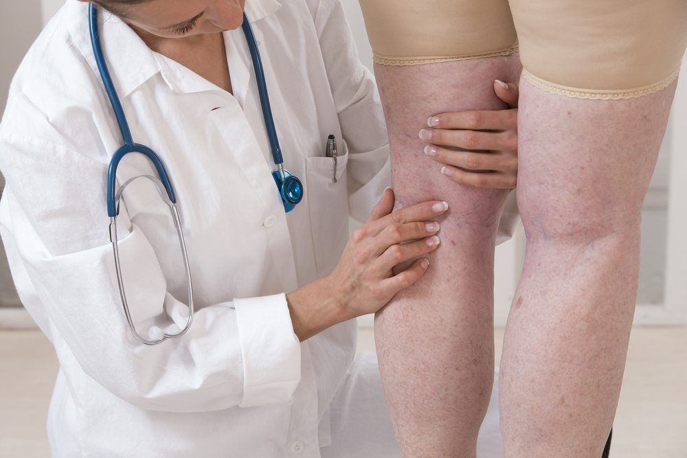 Sclerotherapy