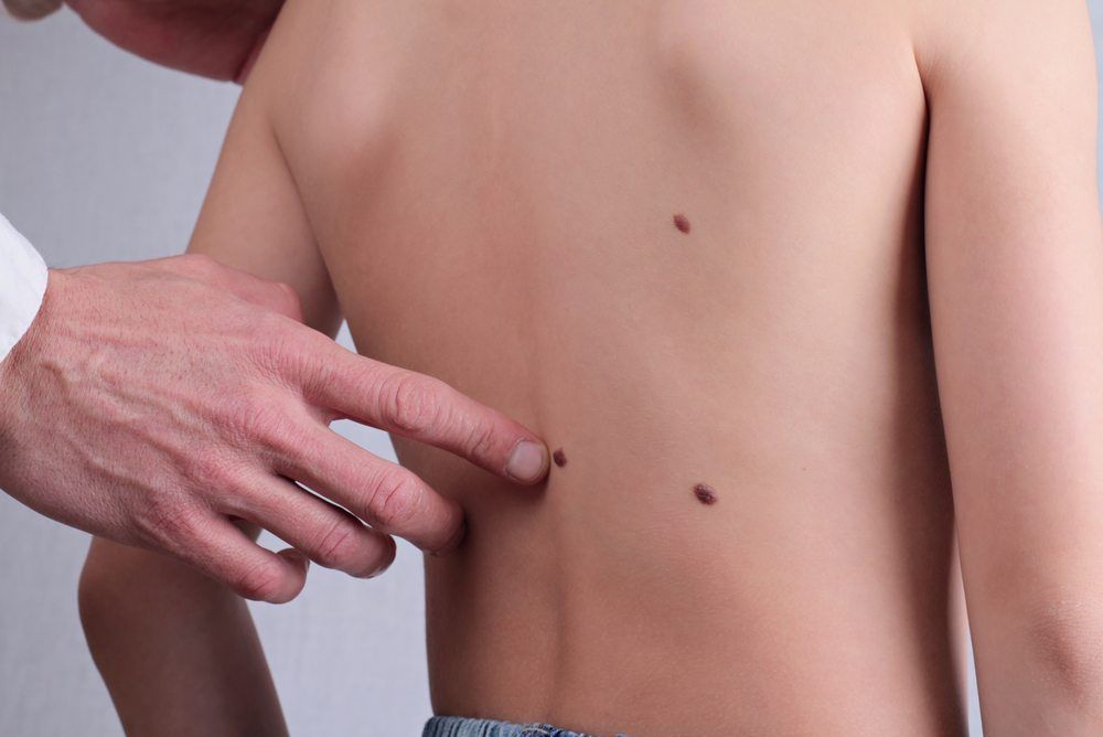 Doctor inspecting moles on childs back