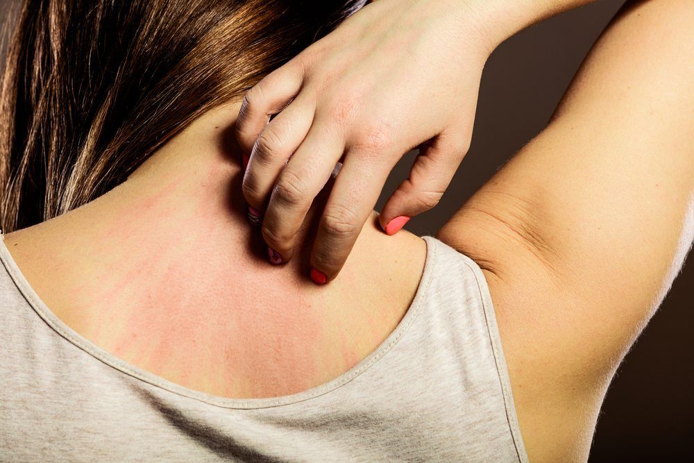 Woman with a Dermatomyositis rash on her back