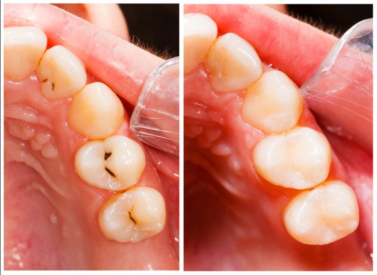 Composite Tooth-Colored Fillings